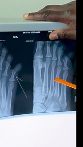 💥Buddy Taping for Toe Fractures👣 Not every toe fracture needs a cast or surgery. For simple fractures—especially of the smaller toes—we use a simple but effective trick called buddy taping 🩹 👉 We tape the injured toe to its neighbor for support. 👉 The healthy toe acts like a “buddy splint,” keeping the broken one straight and stable. 👉 It allows early walking and faster return to normal shoes. Sometimes, the simplest treatments are the most effective! #Orthopaedics #FootAndAnkle #ToeFractu