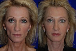 Juvéderm Voluma XC - Injectable Filler - Santa Rosa and Healdsburg