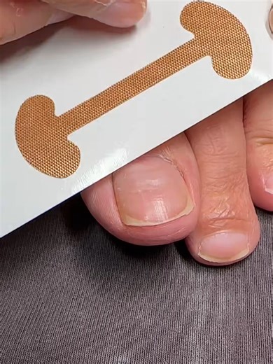 Ingrown Nail Corrector Stickers for Relief