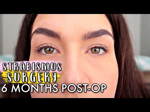 ESOTROPIA STRABISMUS SURGERY UPDATE 6 MONTHS POST-OP 2020 | STRABISMUS SURGERY Before And After!