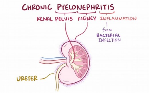 【搬运osmosis】Chronic pyelonephritis (urinary tract infection)