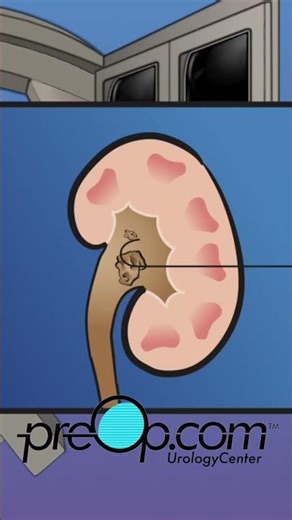 🔍 PreOp® Kidney Stone PCNL 💡 Inside the OR: Access & Stone Removal ✨ #shorts