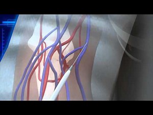 How propofol overdose killed Michael Jackson