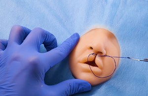 How Cleft Lip Surgery Works | Health is Wealth