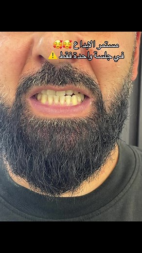 Dr. Hussein Rida protocole#طبيب_اسنان #اكسبلورر #emaxveneers #zirconia #hollywoodsmile #dentistry #teethwhitening #viralvideo #allworldmedia #intraoral #teeth #protocol #بيروت_العرق_سوريا_تركيا_اكسبلور #مصر #لبنان #smilmakeover #doctor #eygpt🇪🇬