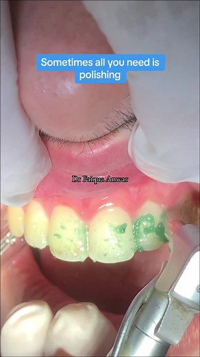 Sometimes all you need is POLISHING to remove stains from your teeth!! #drfaiquaanwar #calculusslayer #anwarsaeeddentistry #foryou #fyp #fy #foryoupage #fypシ #dentist #tooth #viral #teeth #polish #white #smile #scaling
