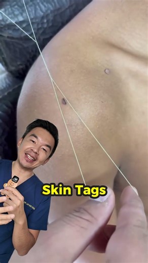 Threading skin tags: how it works