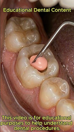 How a Damaged Tooth Is Restored 🦷 Dental Treatment Explained