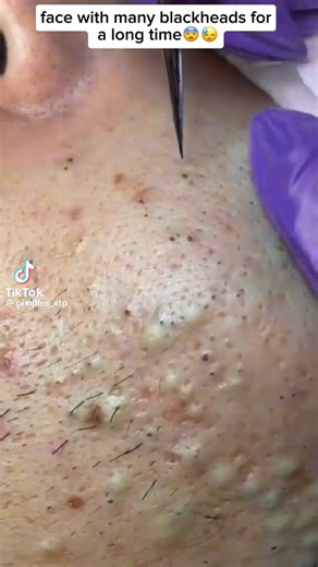 This is exactly why your pimples keep coming back… 😳”“Stop forcing it 😭 you’re making it worse”In this video, see how well it is extracted and learn from it bestie