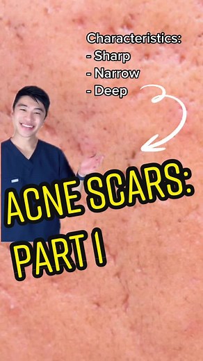 Understanding Ice Pick Scars and Treatment Options