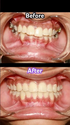 18 Months Braces Deep Bite Fix – Before & After! 😮🦷