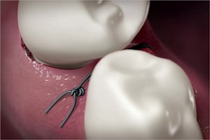 6. Vertical External Mattress Suture - Quintessence Publishing Deutschland