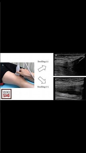 🔍 Suprapatellar Bursa Explained! | Knee Anatomy Quick Guide #meded #anatomy #atc #physiotherapy