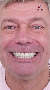 More Than a Smile Makeover | Full-Mouth Rehabilitation in Istanbul