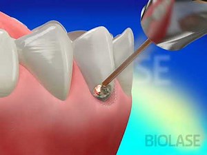 Restorative Class V - Waterlase Laser Dentistry