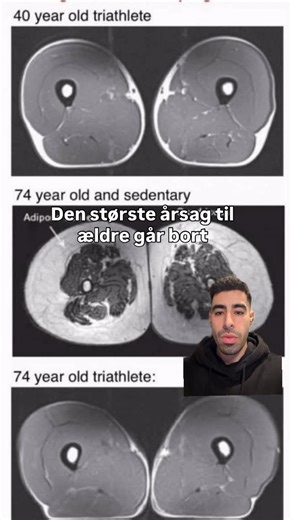 Fysioterapeut , Online Coach og Personlig Træner on Instagram: "Du mister ikke styrke, fordi du bliver gammel. Du bliver gammel, fordi du mister styrke. Sarkopeni er den stille modstander, de færreste taler om. Det er det aldersrelaterede tab af muskelmasse, styrke og funktion – og det starter tidligere, end mange tror. Allerede fra 30–40-års alderen mister vi muskelmasse hvert år, hvis vi ikke gør noget aktivt for at bevare den. Problemet er ikke kun “mindre muskler”. Problemet er konsekvensern