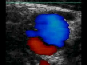 Common Carotid Dissection (SAX)