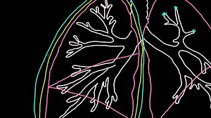 What is a pleural effusion?