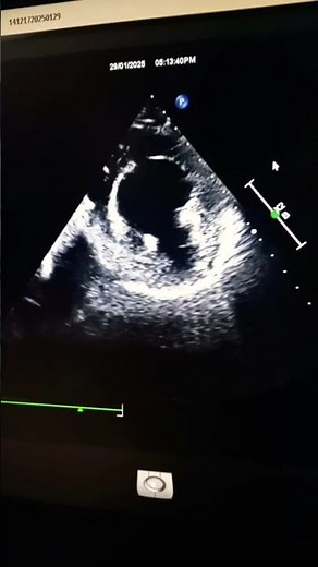 Echo findings:Global LV hypokinesia with RWMA