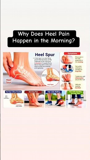Heel Bone Spur Explained in Simple Words