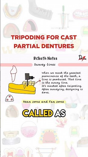 Tripoding For Cast Partial Dentures