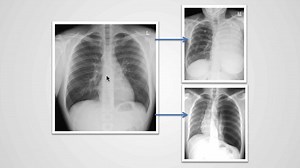 Understand how pathology can change the greyscale of an X-Ray image. You’ll learn about things like pneumothorax, pleural effusion and much more. If you want to take your chest X-ray skills to the next level, then check out our Chest X-Ray Essentials course: https://bit.ly/2OKNF5H | Medmastery