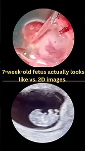 7 Weeks Pregnant | 7weeks baby #babydevelopment #7weekspregnant #ultrasound