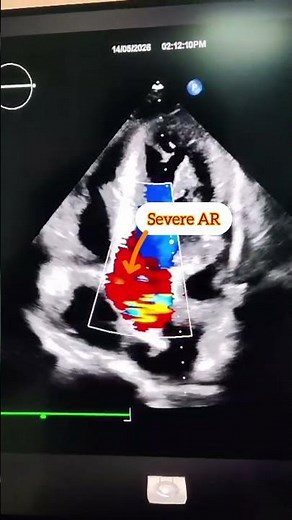 “When the aortic valve fails to close properly… severe AR begins 🫀⚠️"