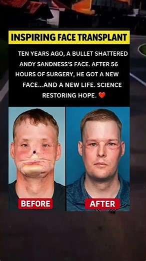 Man Gets New Face After 56-Hour Surgery – Incredible Face Transplant Story