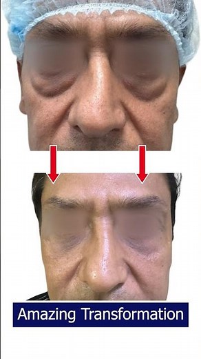 Lower Eyelid Blepharoplasty Surgery | 1 Week Lower Eyelid Result | Essence Cosmetic Surgery