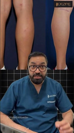 All about calf implant