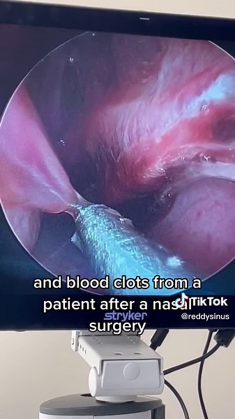 Suctioning snot from the nose. After sinonasal surgery, we routinely clean out the inside of the nose during the healing phase. Saline sinus irrigations also help clean the area. #sinusrelief #sinus #sinussurgery #sinussurgeryrecovery #postop #ent