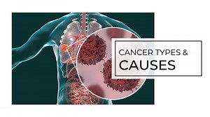 Cancer types and causes - SlideServe