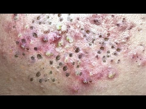 Blackhead Removal With Sac Dep Spa @100074639