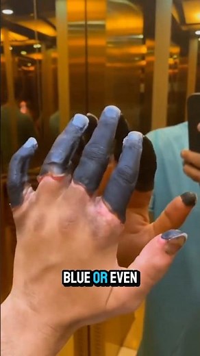 Frostbite Warning Signs You Should Never Ignore | Stay Safe in Extreme Cold