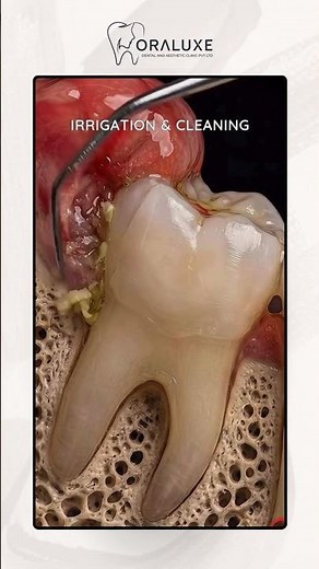 Gum Infection Near Wisdom Tooth? ⚠️