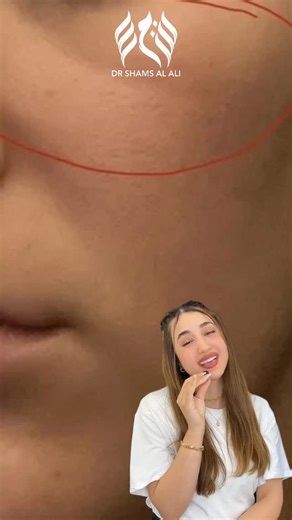 Mid cheek groove هذه الخسفة اللي تقسم خدكم وتكون ممتدة من تقعر العين للاسف اسبابها وعلاجها تابعو الفديو 🤍🤍👍🏻✅ د. #شمس_العلي 👩🏼‍⚕️ بغداد/ المنصور / ١٤ رمضان / مجاور مرطبات / في عمارة ماكسي مول الطابق ال٣ د.شمس العلي / مركز اسينات للحجز والاستفسار: ارسال 💌اسم ورقم هاتف واليوم ونوع الجلسة او الاتصال على 📲 واتس اب او عادي على : 07750010085 07850010085 #beauty #aesthetic #تجميل #explore #dr #lip #filler #جمال #fillers | د. شمس العلي