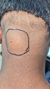 Large scalp lipoma | Dr. Khaled Hasan Milu