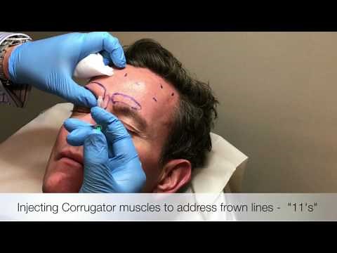 Injecting Procerus and Corrugator muscles