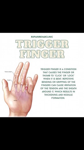 Understanding Trigger Finger Symptoms and Causes