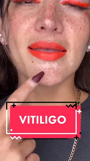 Understanding Vitiligo: Causes, Symptoms, and Advice