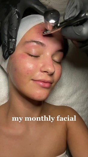 Effective Facial Treatments for Acne-Prone Skin