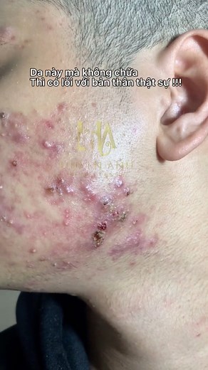 155K views · 441 reactions | 2️⃣ “At our spa, we don’t pop pimples — we make them pack up and leave!  | Thảo Dược Trị Mụn - Trắng Da | Facebook