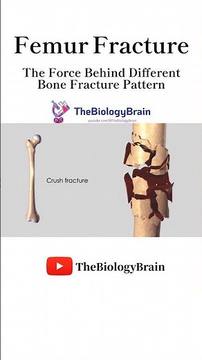 Femur Fractures Explained. #shorts #femurfracture #health #orthopedics #youtubeshorts