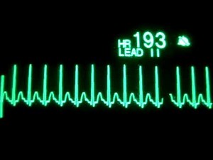Supraventricular Tachycardia