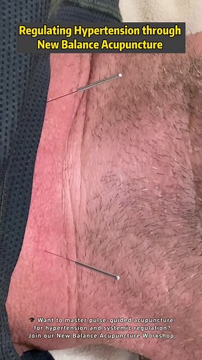 In the New Balance Acupuncture (NBA) system,hypertension is not simply “high blood pressure.” It is the body’s signal of Qi reversal, Yin–Yang imbalance, and structural tension disrupting natural flow. 🧭 The therapeutic goal is not only to reduce numbers, but to restore balance through three key layers: ✅ Structural Correction — relaxing the neck, thorax, and Yangming pathways to ease vascular tension. ✅ Meridian Regulation — harmonizing the Liver and Kidney channels so Qi can rise and descend 