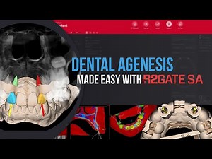 R2GATE SA Tutorial Series | Clinical 1 : 🦷⚙️ How R2Gate SA Simplifies Dental Agenesis Cases
