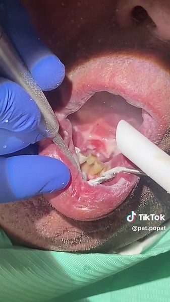 Let’s get rid of the stains with air polishing ✨ #fyp #airpolish #dental #cleantok