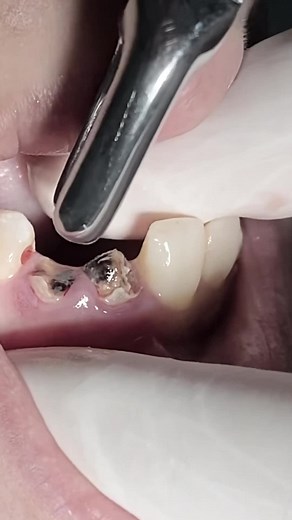 Root Extraction and Bridge Replacement Procedure