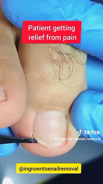 Understanding Ingrown Toenail Removal Process